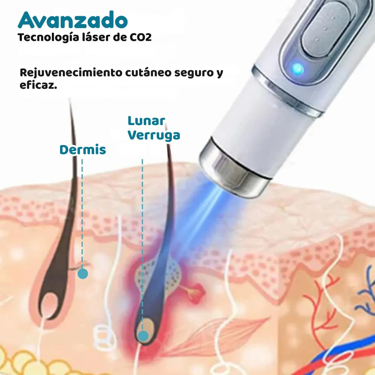 Lápiz Láser De Luz Azul Para El Tratamiento Del Acné Y Las C