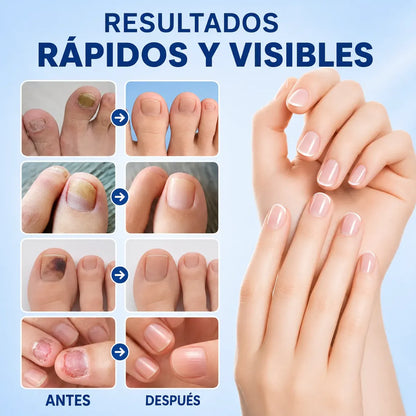 Parches Para Hongos Uñas Tratamiento Reparador Nocturno 21un